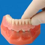 Implant dentar