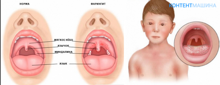 Tratamentul simptomelor laringitelor alergice