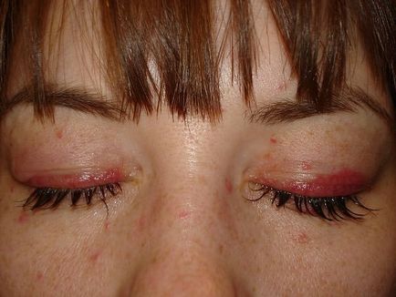 Алергія на нарощені вії - причини, симптоми і лікування