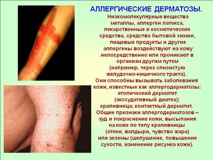 Alergia la genele extensibile - cauze, simptome și tratament