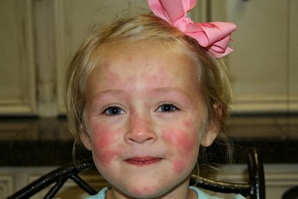 Alergii la un copil de 3 ani de cauză și tratament