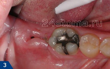 Альвеолит лунки зуба, причини виникнення та лікування