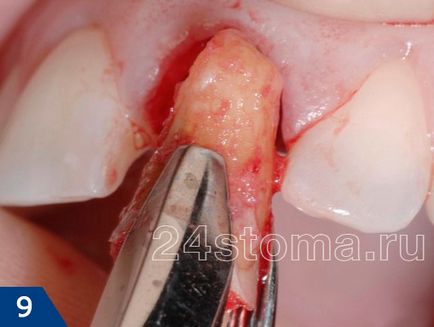 Альвеолит лунки зуба, причини виникнення та лікування