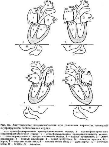 Аномалії внутрішньогрудинного розташування серця