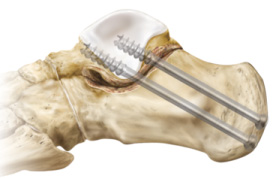 Osteoarthritis lábujjak tünetei és kezelése osteoarthritis talo-patahenger közös láb