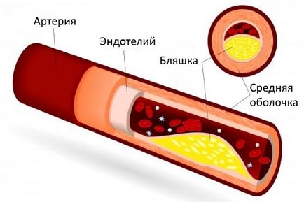 Ateroscleroza simptomelor și tratamentului arterelor brachiocefalice (bzza)