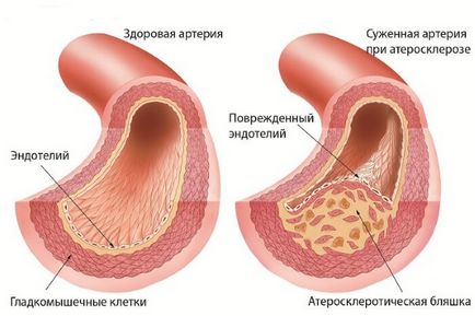 Atherosclerosis brachiocephalica (BCA) tünetek és kezelés