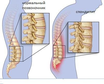 Блокада грижі поперекового відділу