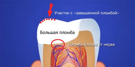 Болить зуб після пломбування чому це може відбуватися
