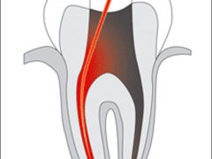 Болить зуб після пломбування чому це може відбуватися