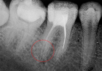 Болить зуб після пломбування чому це може відбуватися