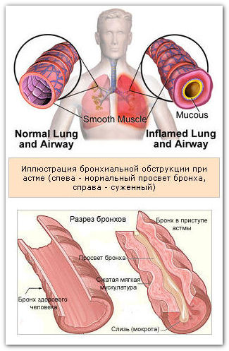 Astmul bronșic - cauze, patogeneză, simptome, diagnostic, complicații, prognostic