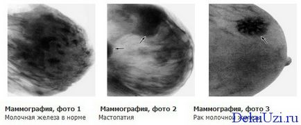Ce este o mai bună mamografie sau ultrasunete mamar decât este diferită