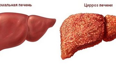 Цироз печінки - опис, причини, симптоми, лікування