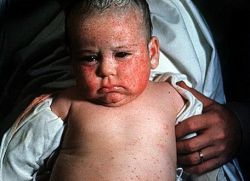 Цитомегаловірусна інфекція у дітей
