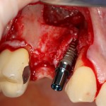 fogászati ​​implantátumok