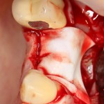 Fogászati implantáció (implantáció) fogászati implantátumok