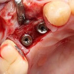 fogászati ​​implantátumok