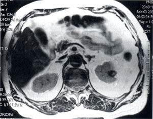 Diagnosticul și tratamentul formelor fluide ale rinichilor - alieni yu