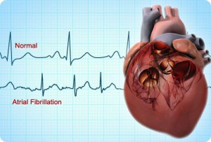 Dieta cu aritmie cardiacă - tratament cardiac