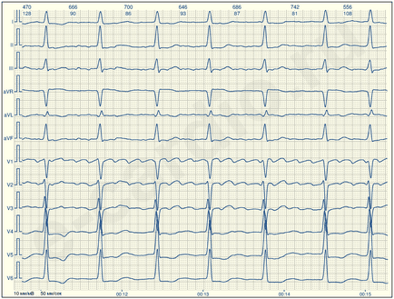 E-cardio flutter atrial