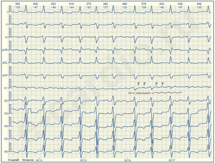 E-cardio тріпотіння передсердь