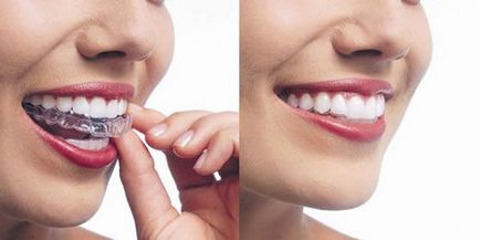 Елайнери для вирівнювання зубів опис, фото до і після