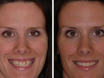 Елайнери для вирівнювання зубів опис, фото до і після
