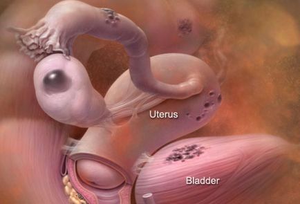Endometrioza a corpului uterului, ce este aceasta, semnele endometriozei interne, difuze ale corpului uterului 1
