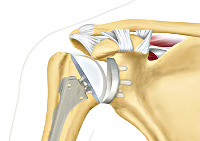 Endoproteticele articulației umărului - prețurile la mosc, au găsit 52 de prețuri