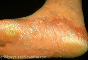 Epidermophytia pe picioare