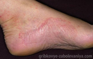 Epidermophytia pe picioare