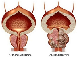 Proprietăți farmacologice ale amoxiclavului și utilizări specifice pentru prostatită