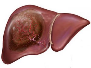 Forum disconfort părinților în hipocondrul drept, poate înfundarea hepatică de sub coaste