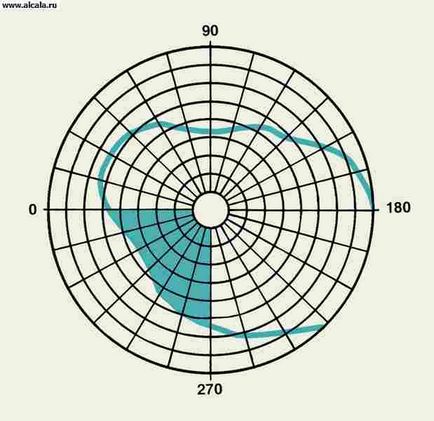 Hemianopsia Medical Encyclopedia