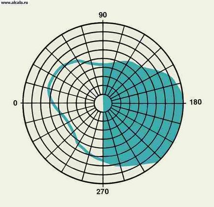 Hemianopsia Medical Encyclopedia