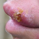 Infecții herpetice la copii, simptome