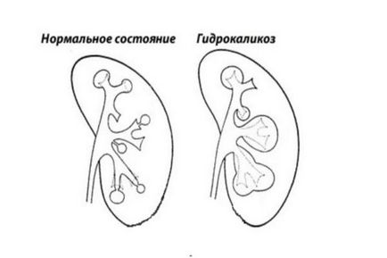 Hidrocalitatea rinichilor (stânga, dreapta, ambele) ce este, tratamentul