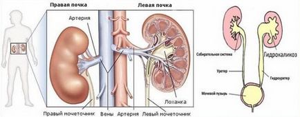 Hidrocalitatea rinichilor (stânga, dreapta, ambele) ce este, tratamentul