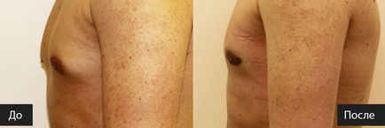 Gynecomastia kezelés működési költségek, az árak Moszkva - Deck Clinic (gynecomastia) Gynecomastia kezelés működési költségek, az árak Moszkva - Deck Clinic