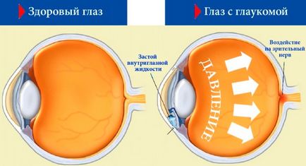 Glaucomul este ceea ce este, simptomele și formele bolii