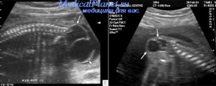 Herniated coloanei vertebrale la făt