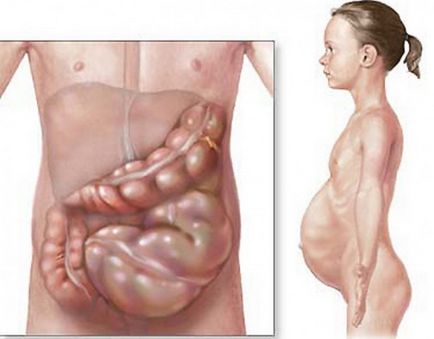 Disability Crohn-betegség, szövődmények, következmények, prognózis, a várható élettartam, mint