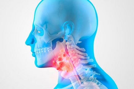 Din cauza cancerului amigdaliilor și a modului de a le detecta