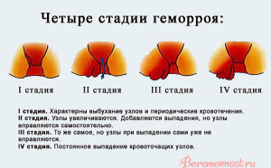 Як лікувати геморой після пологів і кесаревого розтину