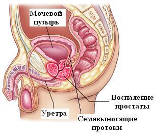 Cum se trateaza prostatita cronica