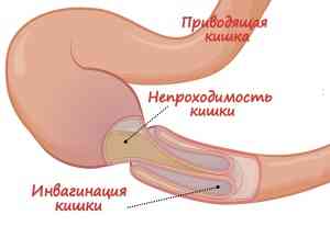 Cum se identifică aderențele la nivelul intestinelor - bolile intestinale -if () - endif - catalogul articolelor - proctologia