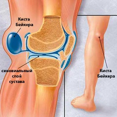 Кіста Бейкера - лікування, операція, видалення