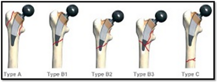 Класифікації періпротезних переломів стегнової кістки (огляд літератури) - сучасні проблеми