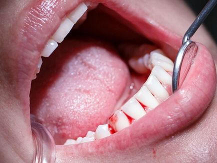 Кровоточать ясна при чищенні зубів лікування і профілактика захворювання